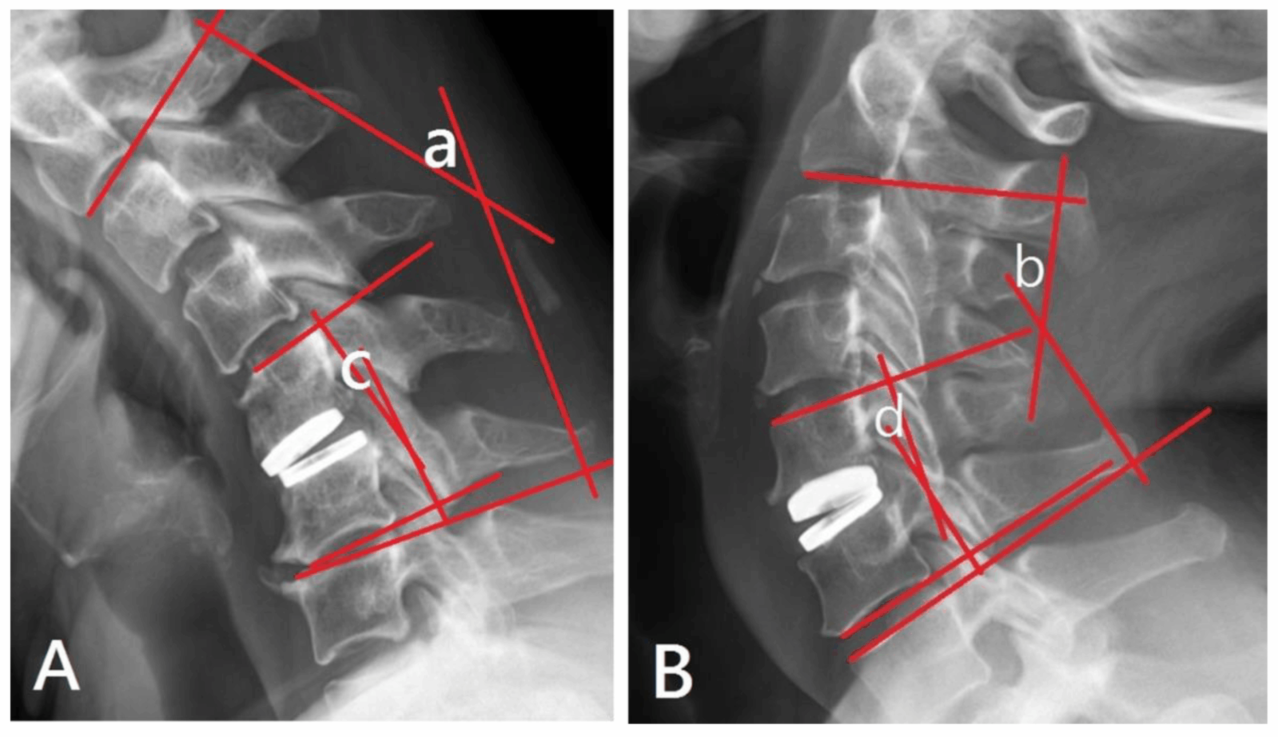 ACDF, cervical disc replacement, posterior cervical stabilization