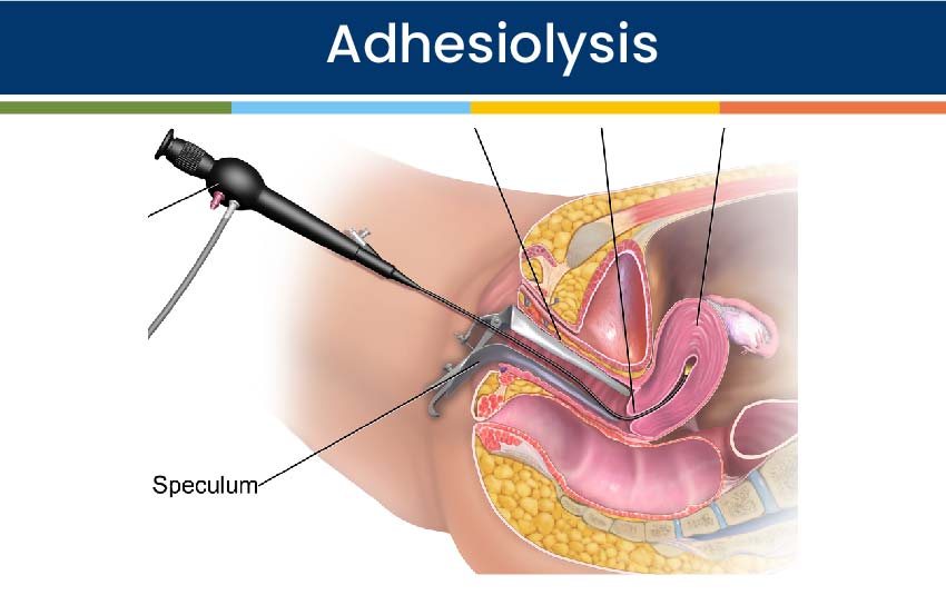Adhesiolysis