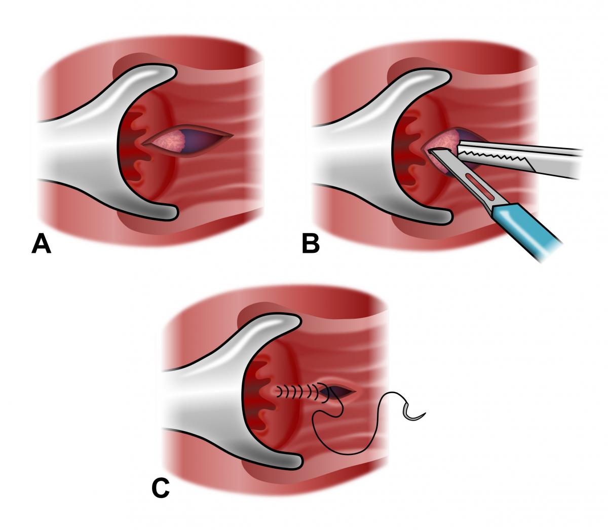 Anal fissure surgery (Sphincterotomy)
