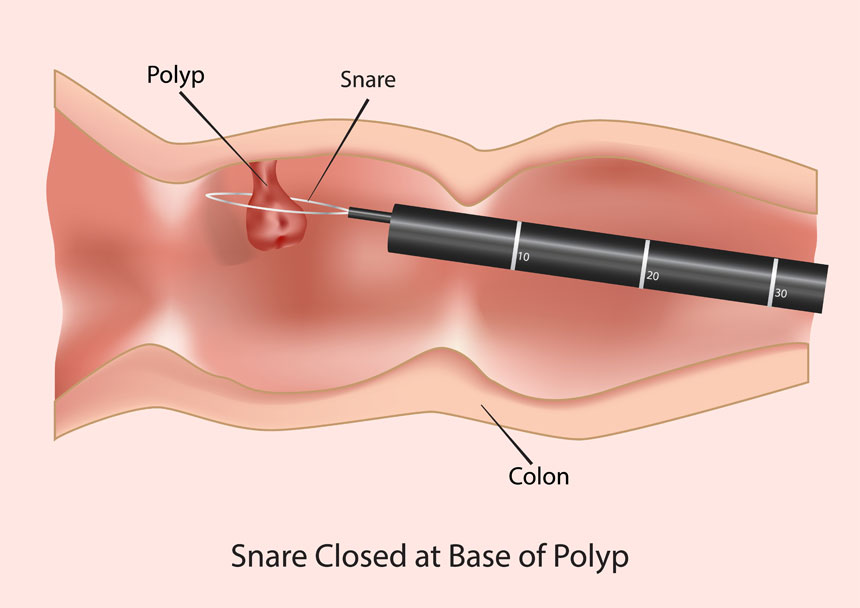 Anal polypectomy