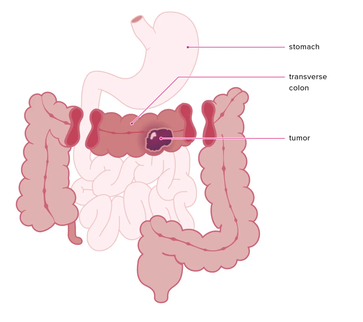 Bowel Resection & Anastomosis
