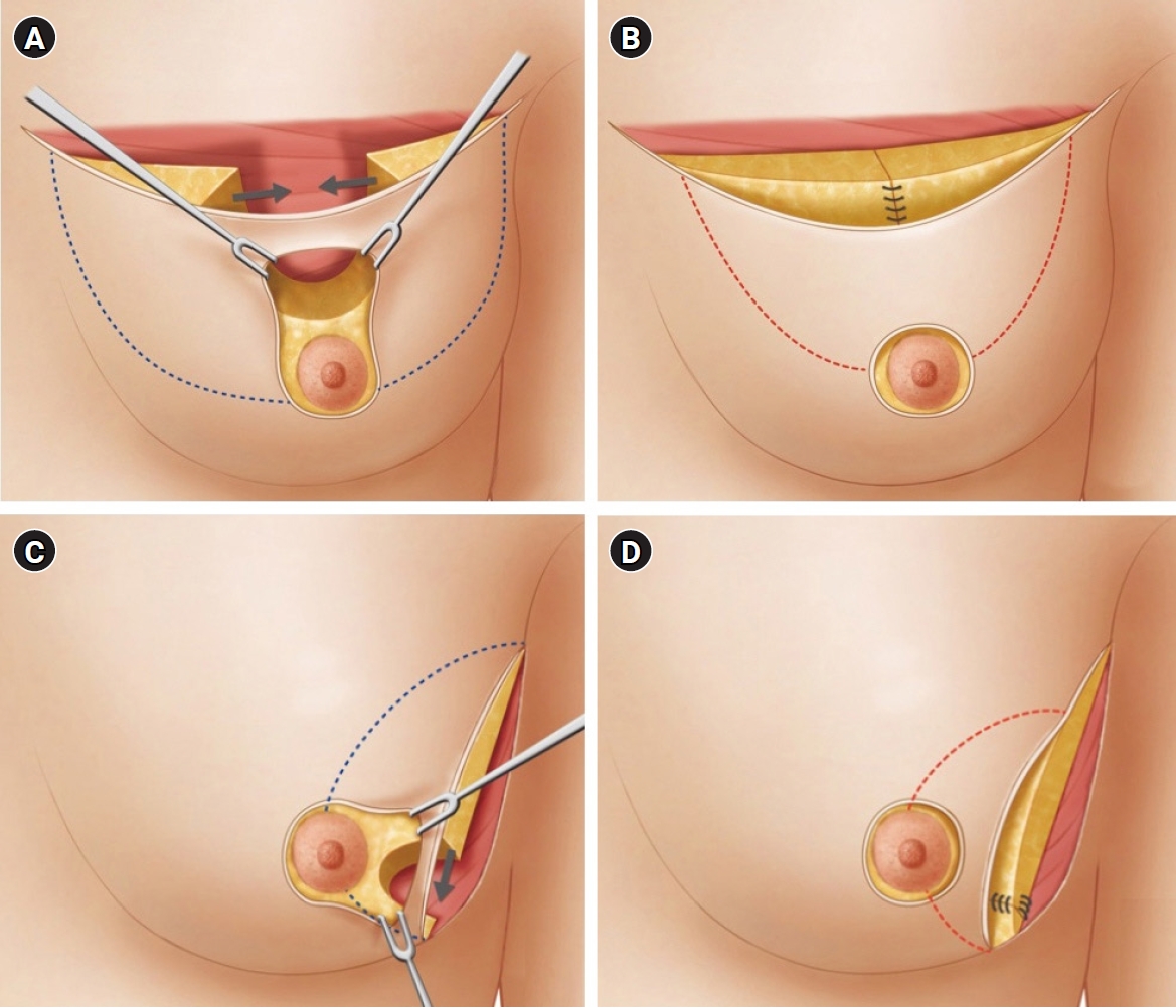 Breast-Conserving Surgery (Lumpectomy)