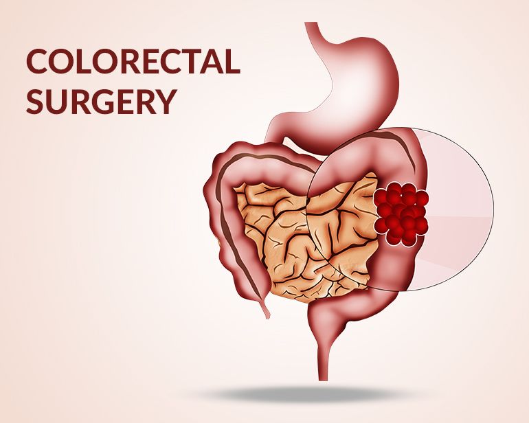 Coloproctology Surgeries (Colon, Rectum, Anus)