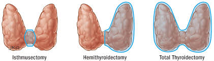 Completion Thyroidectomy