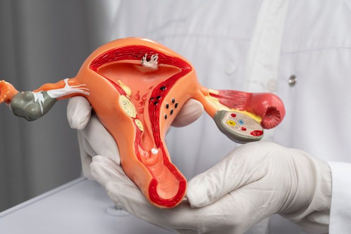 Dermoid Cyst