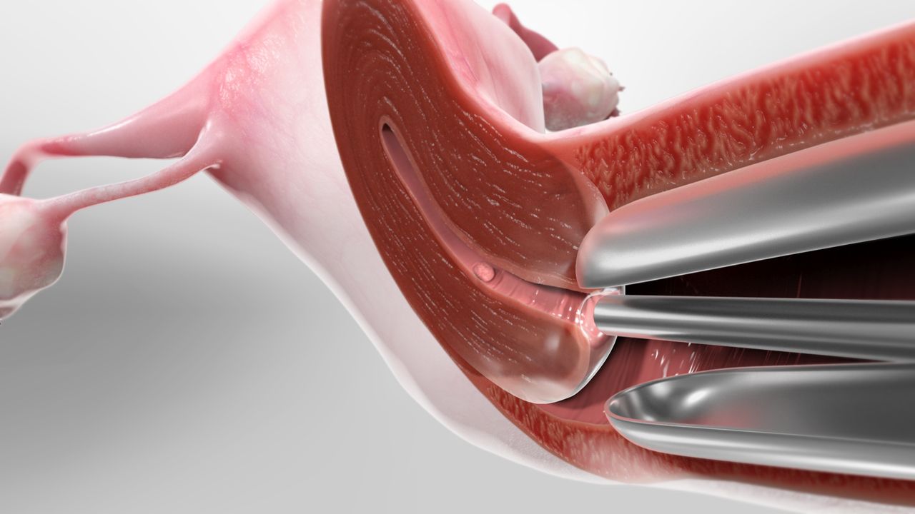 Diagnostic Hysteroscopy