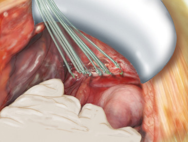 Diaphragmatic Injury Repair