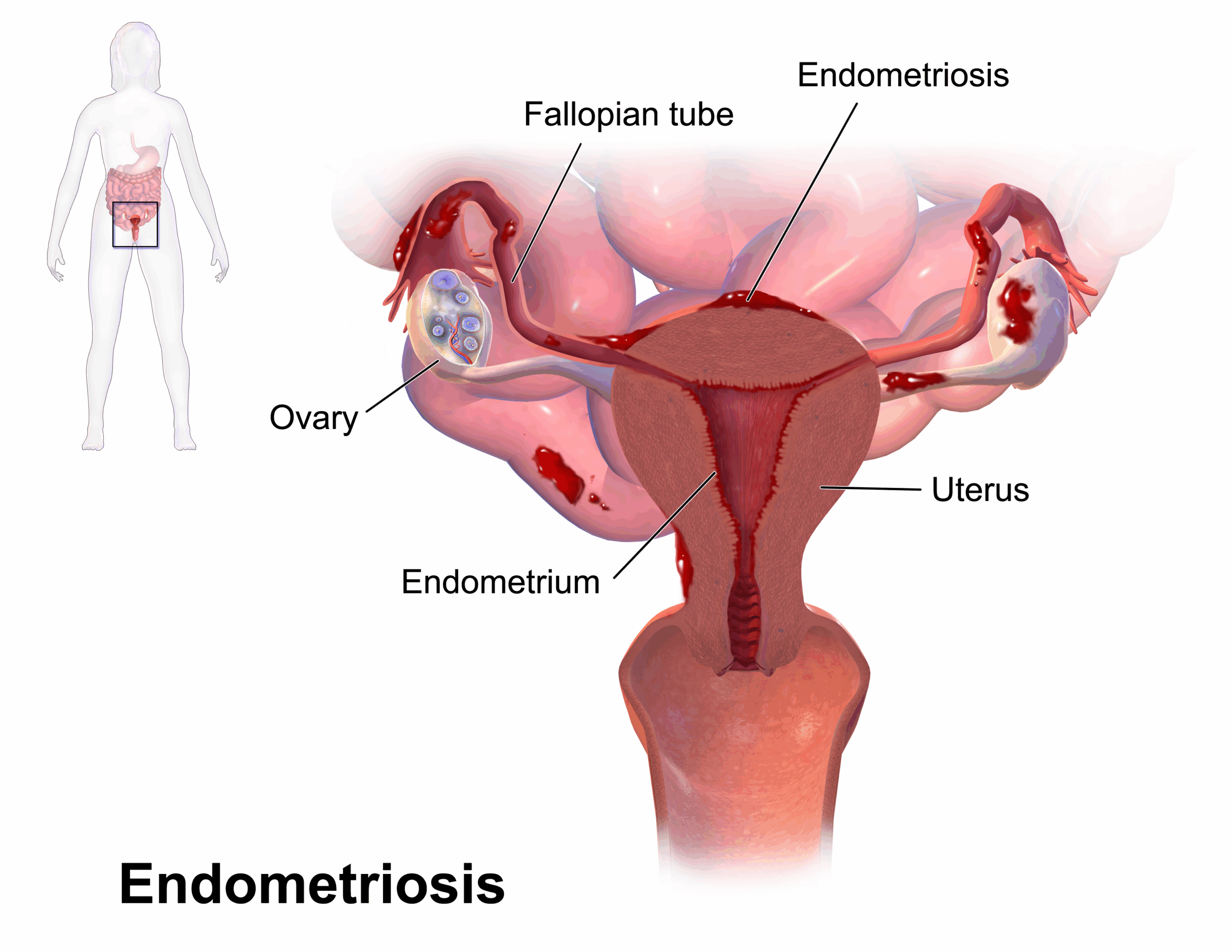 Endometriotic Cyst