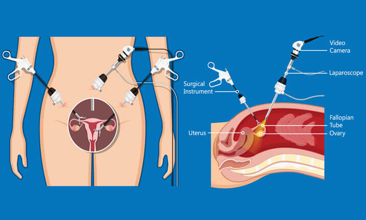 Endometriotic Cystectomy