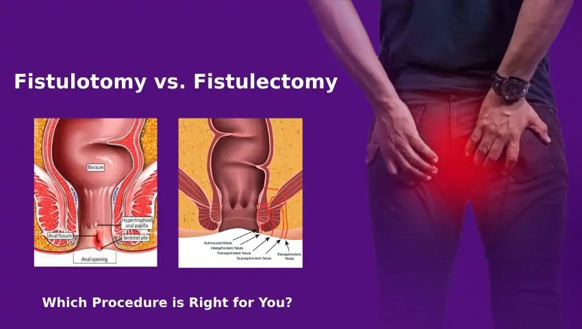 Fistulotomy / Fistulectomy