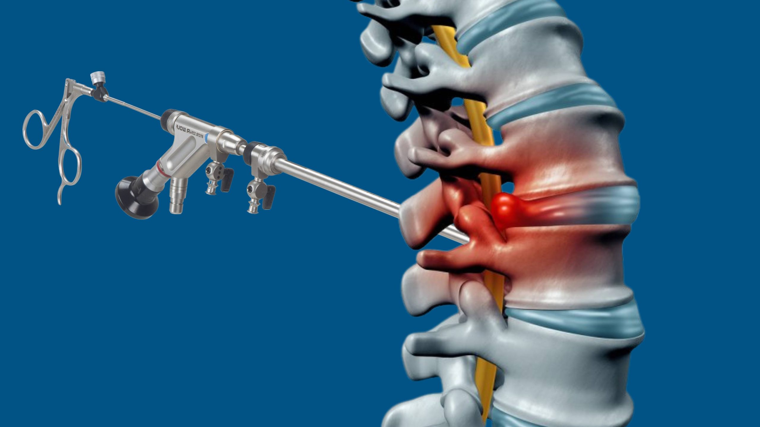 Full endoscopic lumbar discectomy, cervical endoscopic procedures