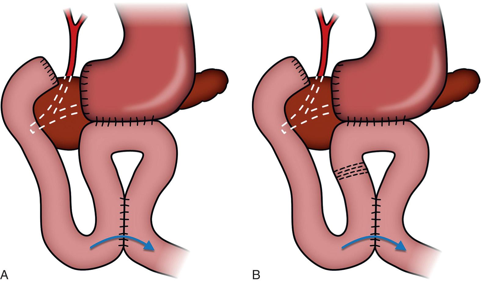 Gastrojejunostomy / Pyloroplasty