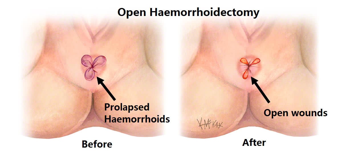 Haemorrhoidectomy (open or stapled)