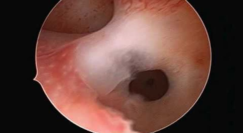 Hysteroscopic Adhesiolysis