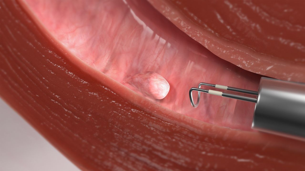 Hysteroscopic Polypectomy