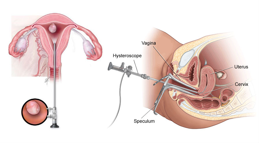 Hysteroscopic Septum Resection