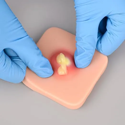 Incision & Drainage of Breast Abscess