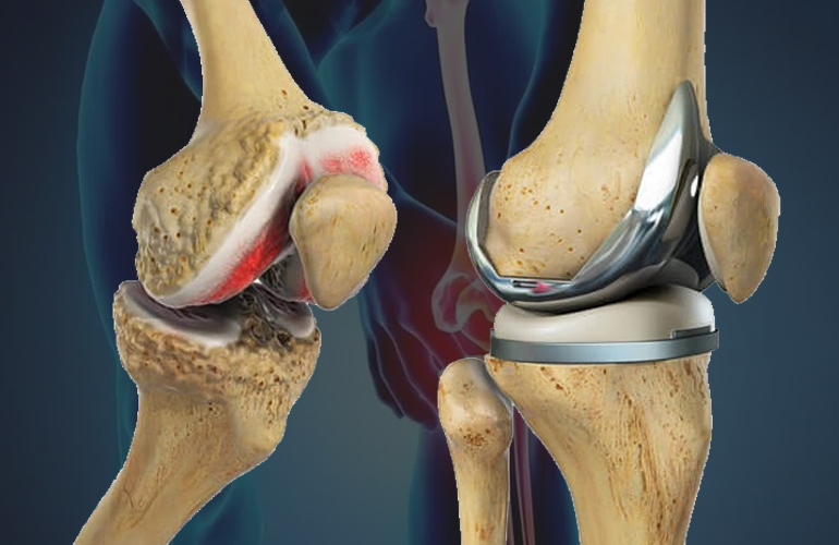 Joint replacement