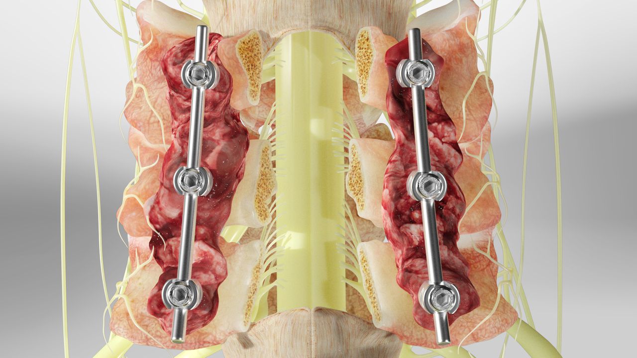 Laminectomy, discectomy, fusion techniques