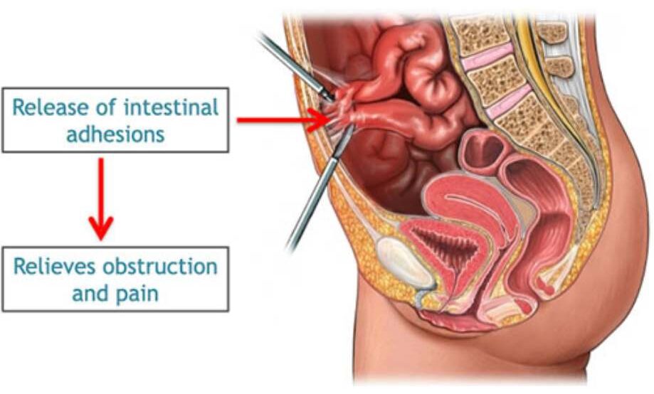 Laparoscopic Adhesiolysis (Pelvic adhesions)