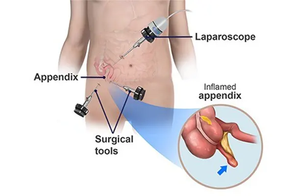 Laparoscopic Appendectomy