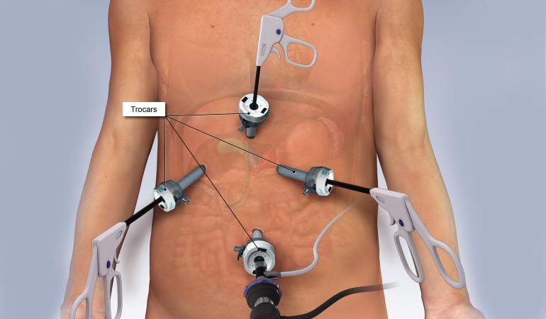Laparoscopic Cholecystectomy (gall bladder stone removal)