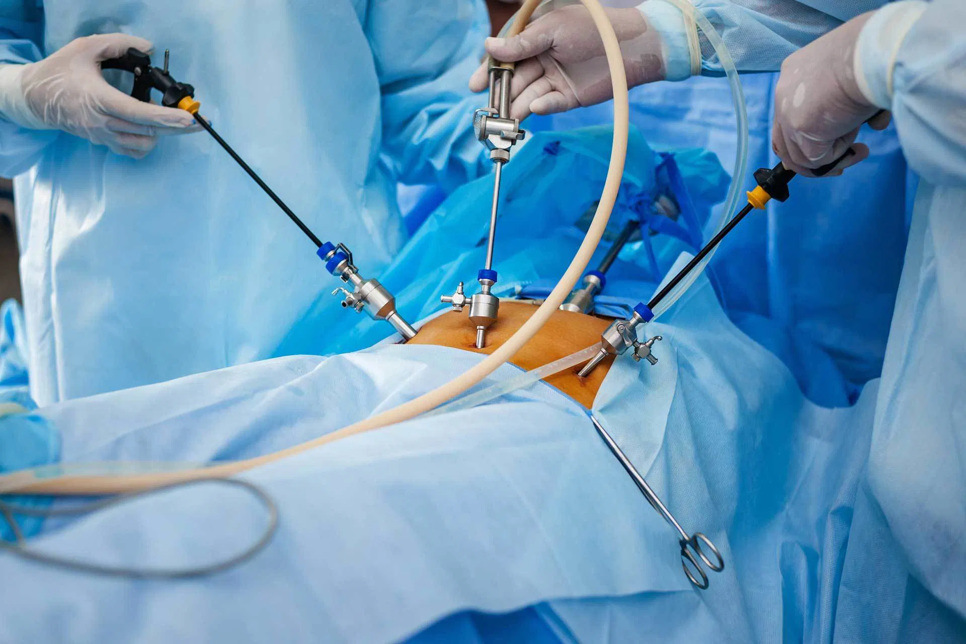 Laparoscopic Cystectomy