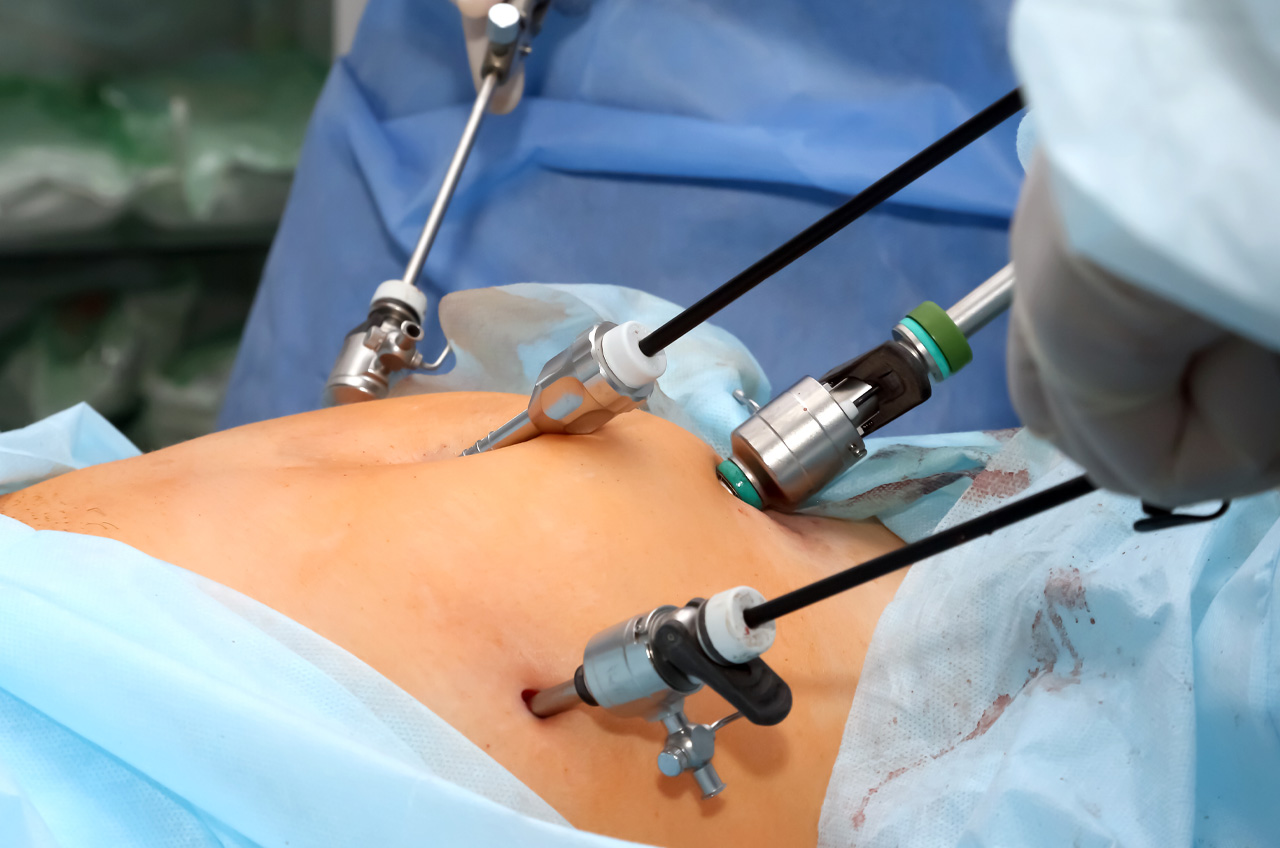 Laparoscopic