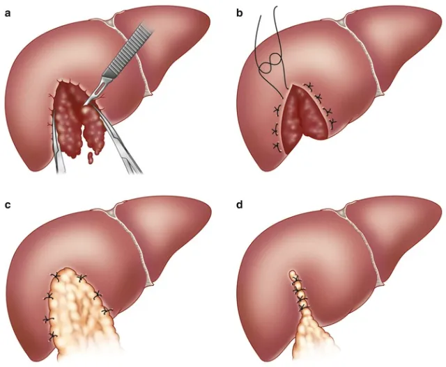 Liver Injury Packing / Hepatorrhaphy