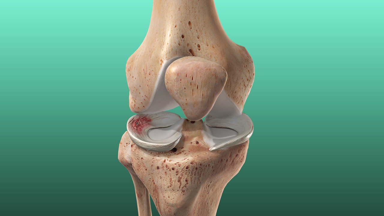 Meniscus Tear & Repair