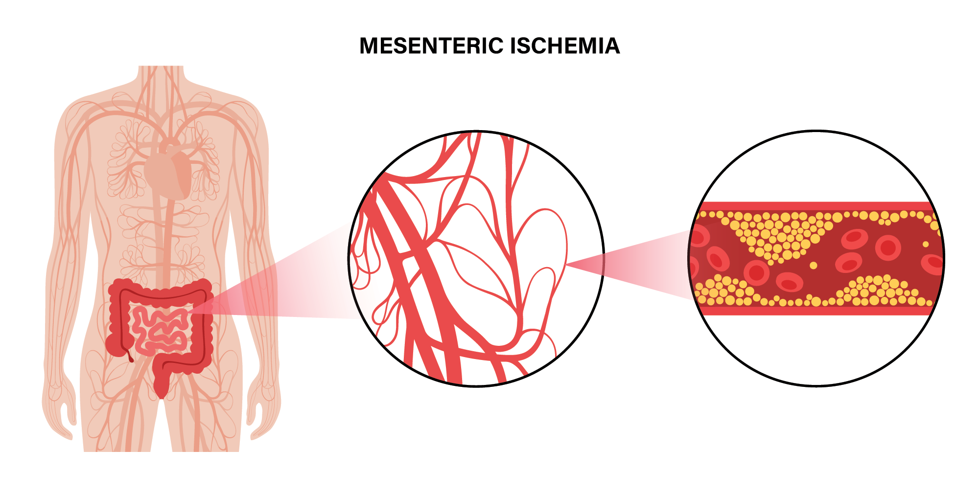 Mesenteric Ischemia surgery