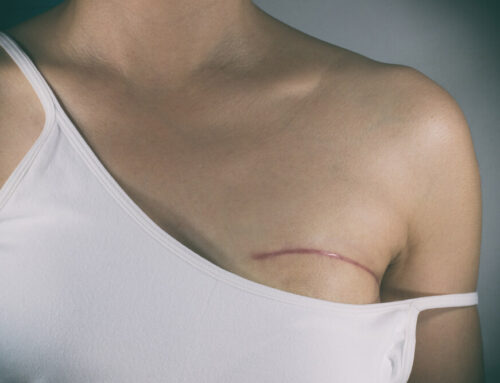 Modified Radical Mastectomy (MRM)