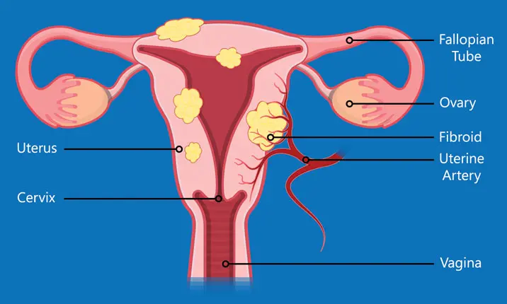 Myomectomy