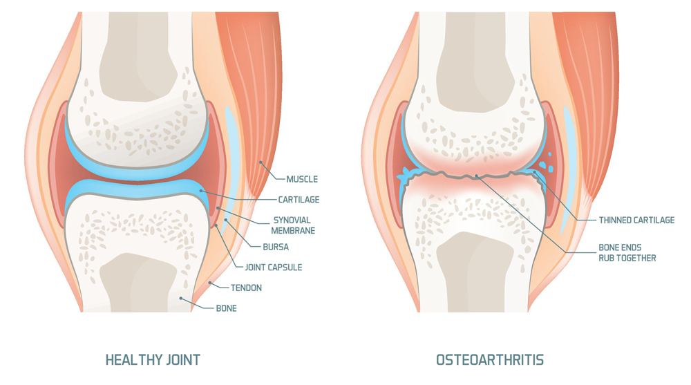 Osteoarthirits