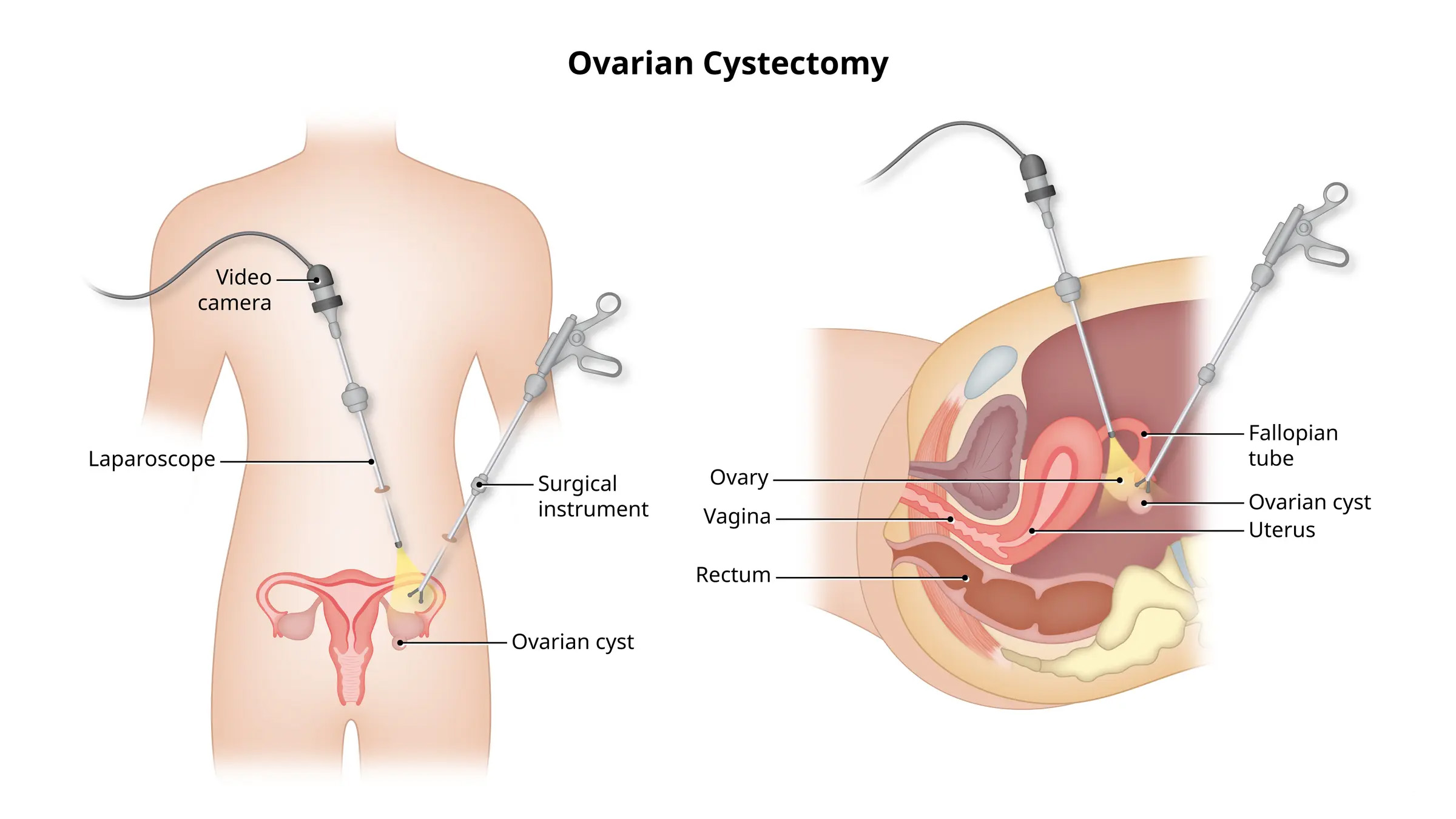 Ovarian Cystectomy