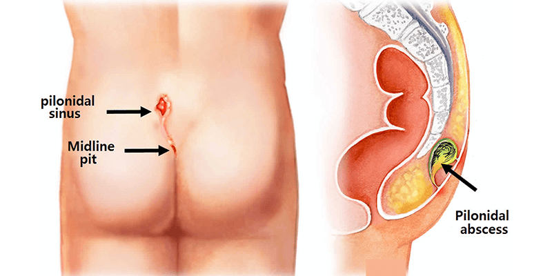 Pilonidal sinus excision