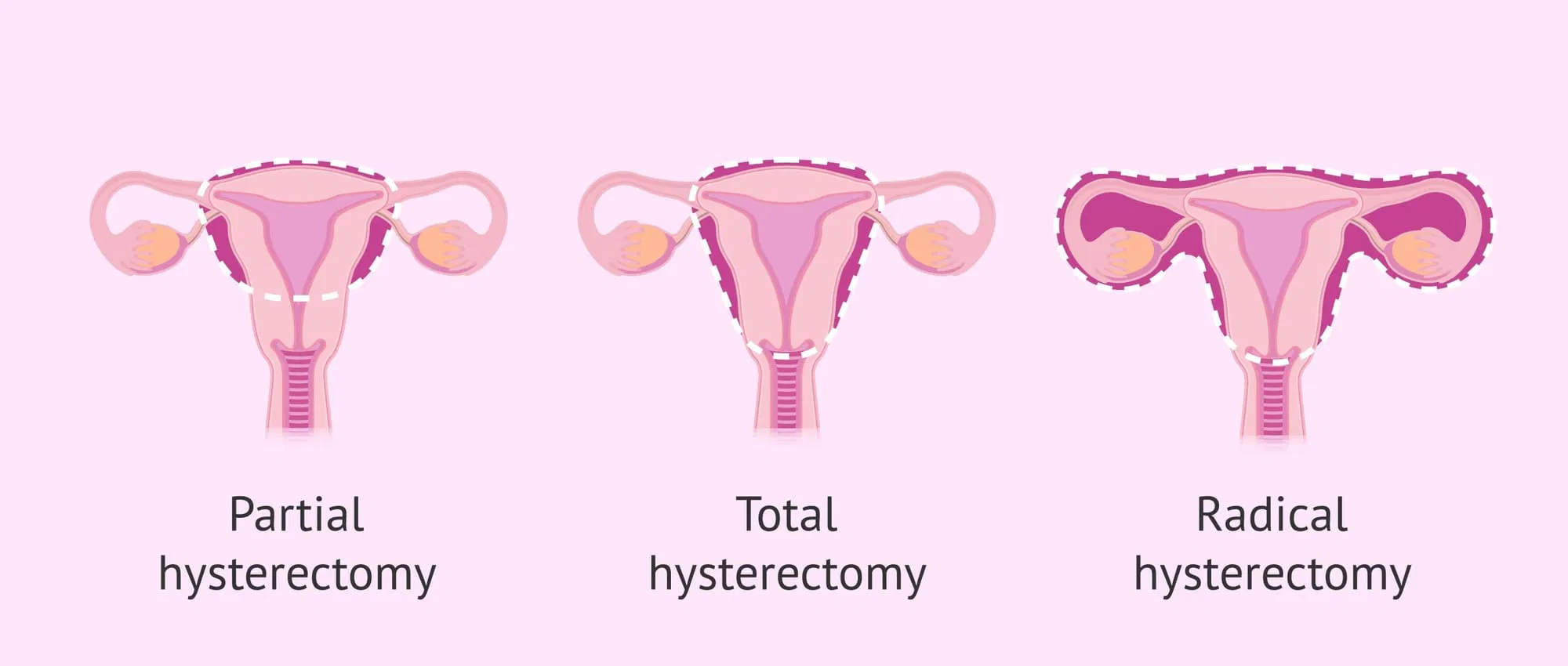 Radical Hysterectomy