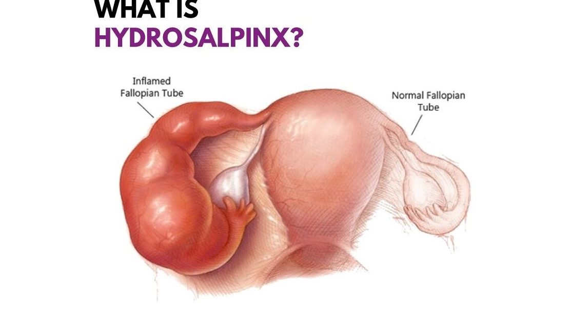 Salpingectomy for Hydrosalpinx before IVF