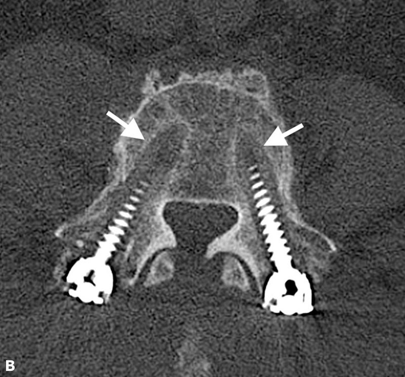 Scar tissue, pseudoarthrosis, adjacent segment disease