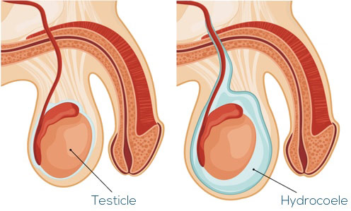 Scrotal swelling & its management
