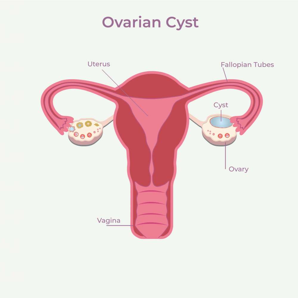 Simple Cyst