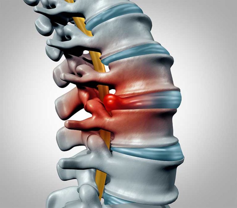 Spinal Infections