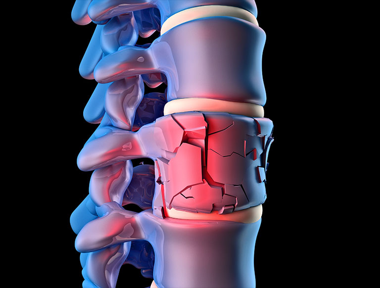 Spinal Trauma Surgery