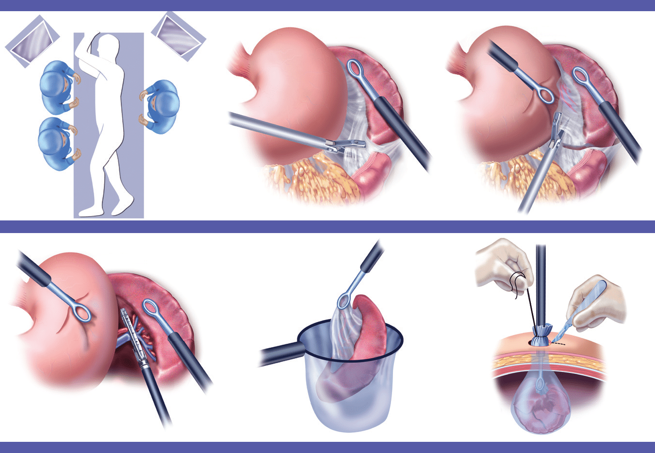 Splenectomy / Splenic salvage procedures