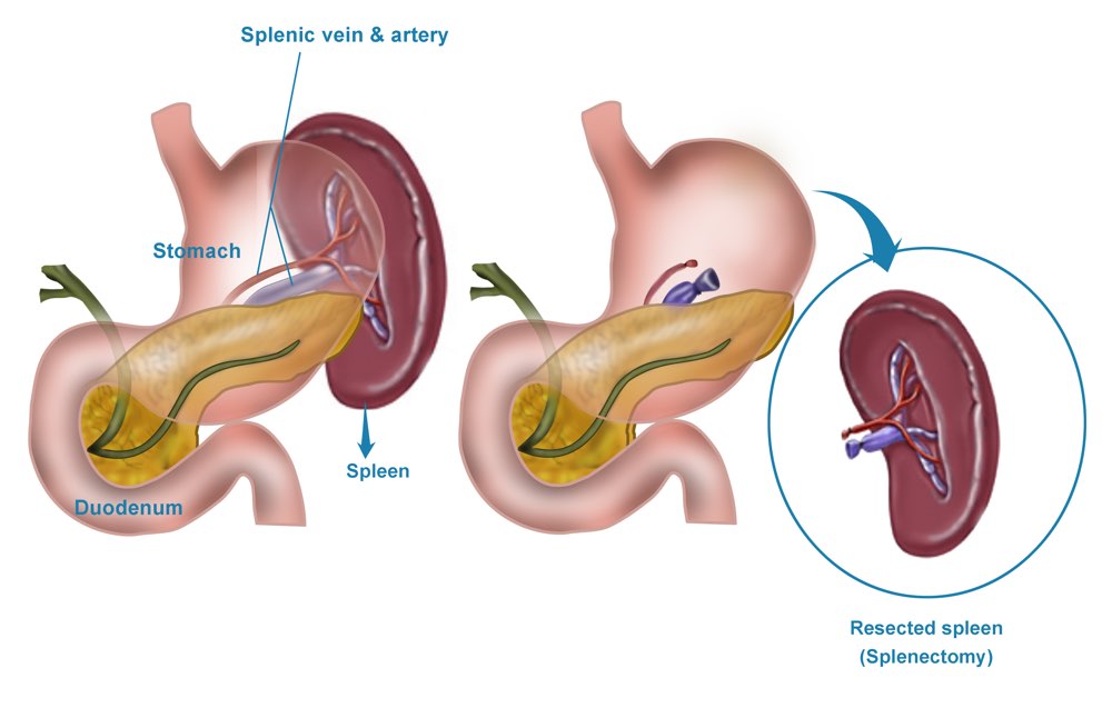 Splenectomy (trauma or hematological disorders)