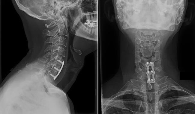 Surgeries for Cervical Stenosis