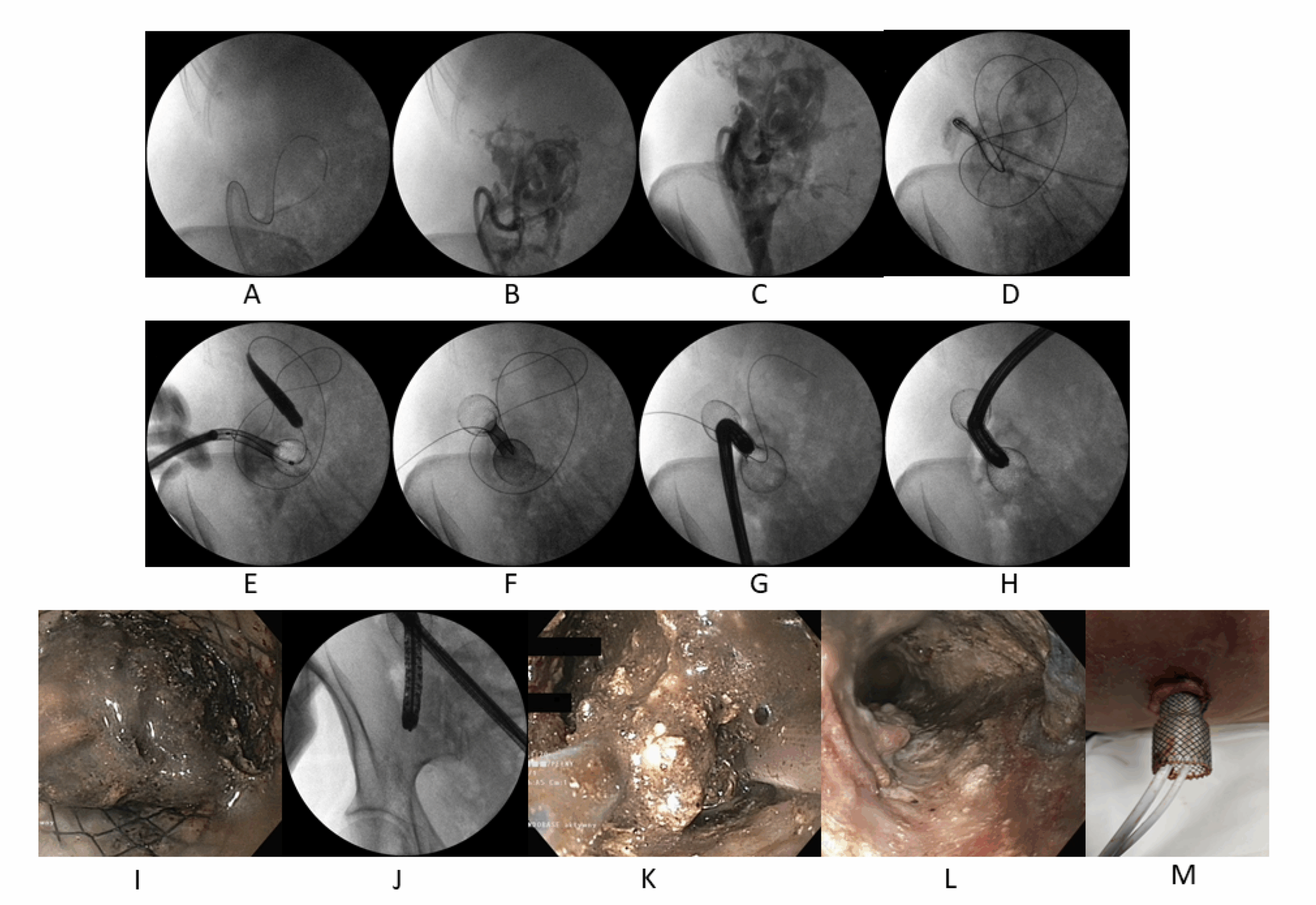 Surgery for Pancreatitis (Necrosectomy, pseudocyst drainage)