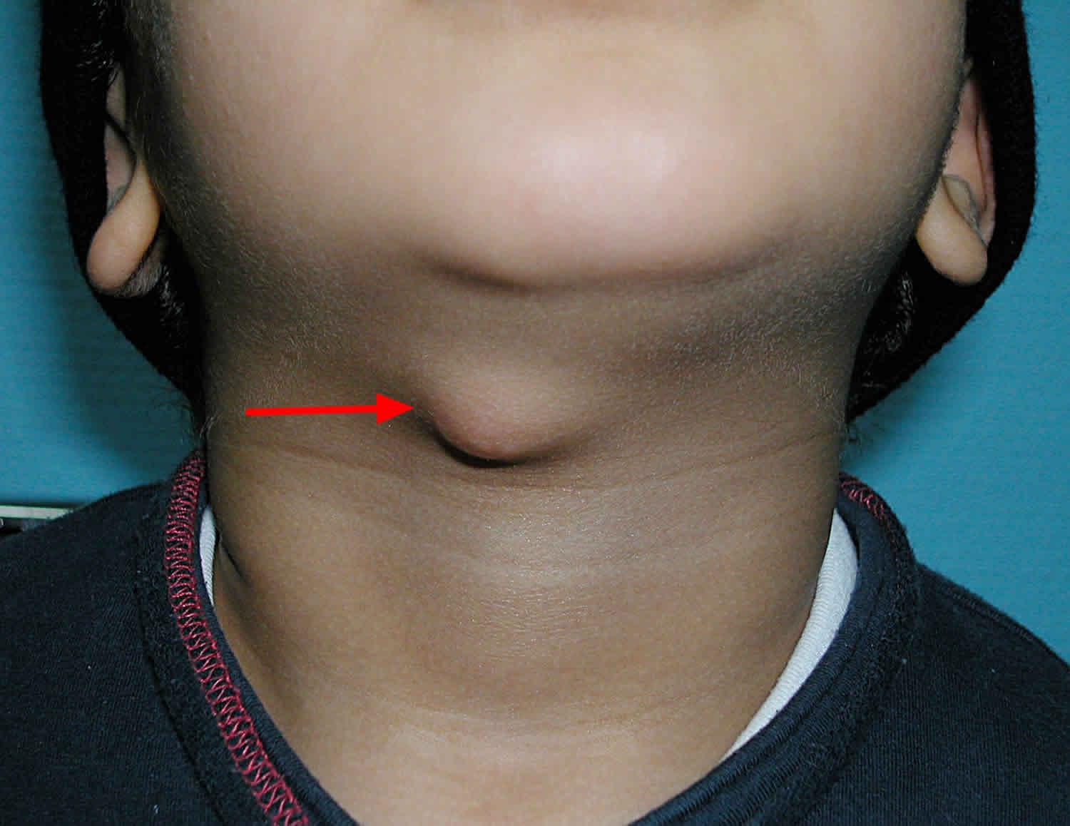Thyroglossal Duct Cyst Excision