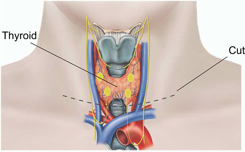 Total Thyroidectomy