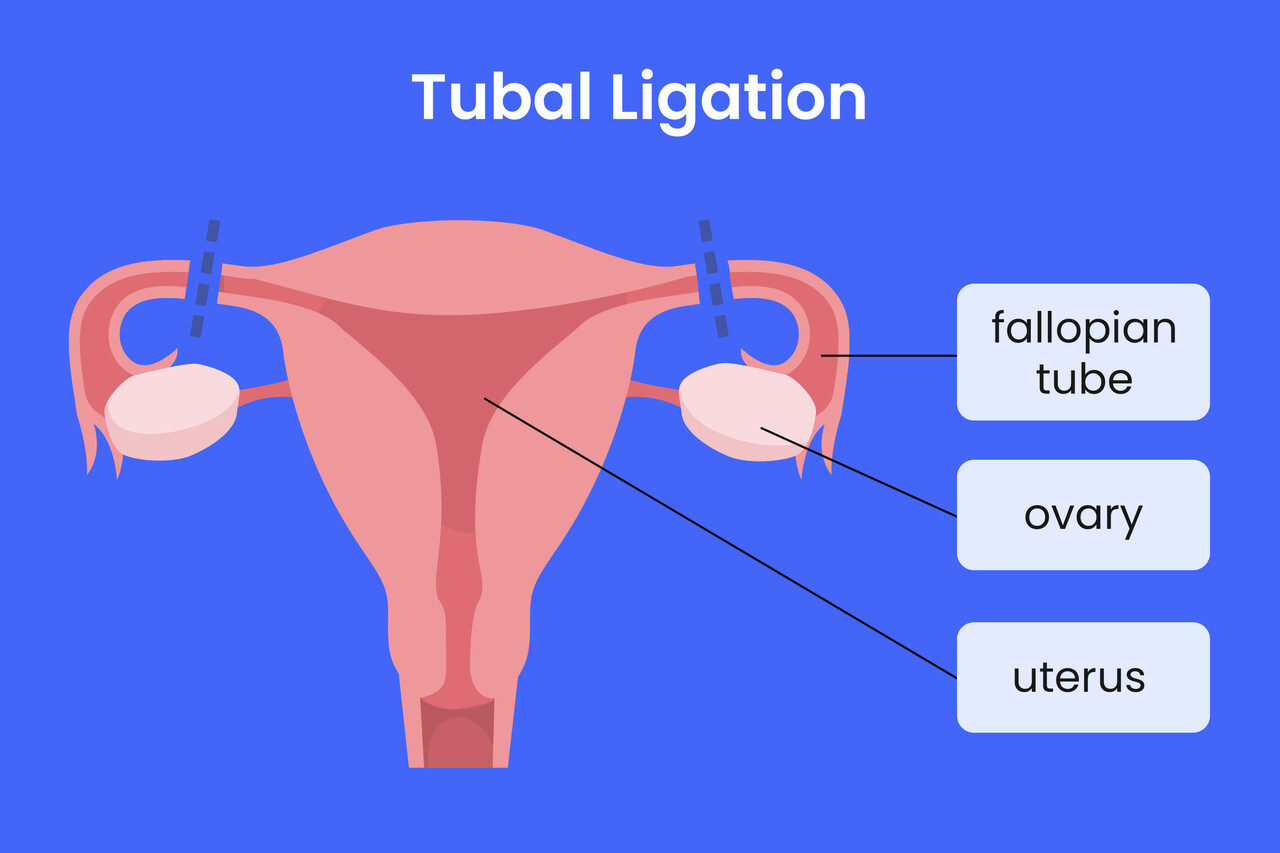Tubal Ligation